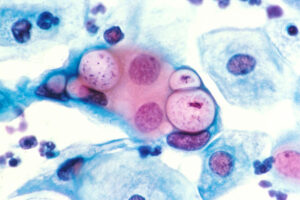 pemeriksaan pap smear